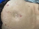 Phình bụng nguy kịch do tùy tiện dùng thuốc Phình bụng nguy kịch do tùy tiện dùng thuốc