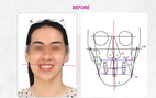 Cân chỉnh đường giữa và chữa lệch mặt bằng phương pháp niềng răng