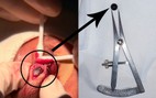 Viên bi sắt 6 mm nằm trong mí mắt nam sinh 15 tuổi suốt nhiều ngày
