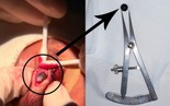 Viên bi sắt 6 mm nằm trong mí mắt nam sinh 15 tuổi suốt nhiều ngày