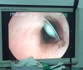 CLIP: Bệnh nhân cao huyết áp suýt trả giá đắt do uống thuốc quá nhanh