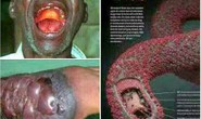 Ebola có lây qua đường tình dục?