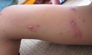 Nằm bệnh viện, bệnh nhân bị kiến ba khoang tấn công