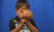 Trả nụ cười cho cậu bé mang khối u khổng lồ trên mặt