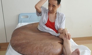 Người đàn ông mang khối u lớn nhất thế giới: 110 kg