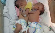 Hội chẩn tách 2 bé gái dính liền