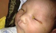 Em bé bị mù một mắt vì chụp hình quên tắt đèn flash