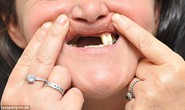 Mất hàm răng cửa vì tẩy trắng răng ở nha sĩ dởm