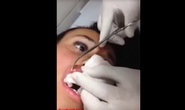 Lấy dòi làm ổ trong môi người phụ nữ