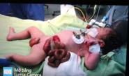 Một bé sơ sinh bị ruột nằm ngoài da hiếm gặp