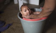 Brazil: Gia tăng trẻ sơ sinh bị tật đầu nhỏ
