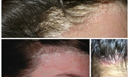 Cảnh báo: Mũ bảo hiểm bẩn gây bệnh nấm da đầu