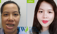 5 giờ cắt hàm cứu cô gái hàng chục năm không ngậm miệng được