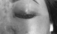 Chủ tiệm spa bị phạt tiền vì tiêm filler gây mù mắt