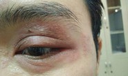 Nhập viện vì thói quen dùng tay đập kiến ba khoang
