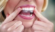 Có nên làm trắng răng thần tốc bằng miếng dán?