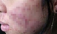 Mặt nữ sinh viên 19 tuổi chi chít mụn sau dùng mỹ phẩm thần thánh làm đẹp đón Tết