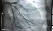 Bị tắc động mạch mà tưởng say rượu, người đàn ông suýt chết