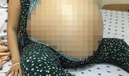 Hiểm họa u nang chuyển sang ác tính