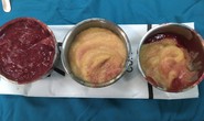 Rút cả lít hóa chất lạ trong ngực nữ Việt kiều