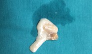 Thanh niên nghiện tiết canh bị hôn mê vì sán ăn não