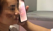 Mặt người phụ nữ loang lổ, đen sạm sau khi lăn kim trị nám da ở spa