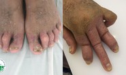 Biến dạng toàn thân do uống thuốc thầy lang trị vảy nến