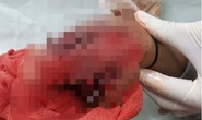 Cắt bỏ bàn tay dập nát của bé trai 9 tuổi do đèn pin phát nổ gây ra