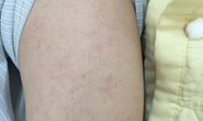 Nữ bệnh nhân 28 tuổi bị biến chứng hiếm gặp sau mắc bệnh sởi