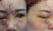Liên tiếp mù mắt sau tiêm filler không đúng chỗ