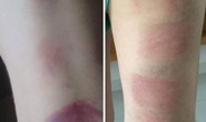 Tạm đình chỉ giáo viên dùng thước đánh 22 học sinh