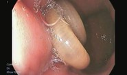 Bắt giun đũa dài gần gang tay trong dạ dày nữ bệnh nhân