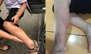 Làm bài kiểm tra học kỳ chậm, học sinh lớp 2 bị cô giáo tát vào thái dương, đánh tím chân