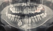 Hi hữu: Lấy gần 100 cái răng trong miệng một thiếu niên ở Khánh Hòa