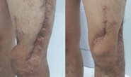 Nam sinh viên được phẫu thuật 6 lần cứu chân suýt phải cắt cụt