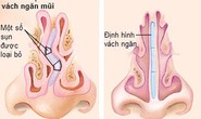 Lệch vách ngăn mũi có cần phẫu thuật?
