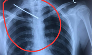 2 giờ phẫu thuật cứu sống 9X bị bạn dùng cây sắt đâm thấu cổ, xuyên phổi