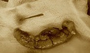 Người đàn ông thủng ruột thừa vì thói quen ngậm tăm