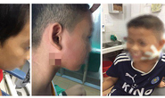 Phát hiện 3 trẻ em ở Nghệ An nhiễm “vi khuẩn ăn thịt người”
