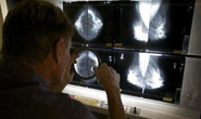 AI có thể giúp chẩn đoán ung thư vú chính xác hơn