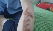 Vụ bé trai quê Quảng Ngãi bị bạo hành dã man: Đánh bằng bàn chải sắt, chày, xẻng