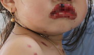 Bé gái 3 tuổi mắc chứng bệnh lạ khiến lở loét toàn bộ 2 môi