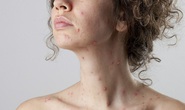 Làm sao để da đẹp lại sau bệnh thủy đậu?