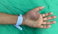 90 phút căng thẳng loại bỏ khối u đáng sợ ở lòng bàn tay bệnh nhân