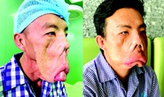Kỳ tích cứu chàng mặt quỷ