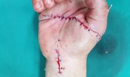 Trở lại làm việc sau giãn cách, bị cưa máy chém đứt gần lìa bàn tay