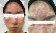 Detox da tại spa, cô gái nhập viện với khuôn mặt đầy mụn