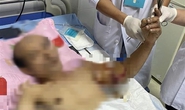 Nối cánh tay đứt lìa cho người đàn ông 50 tuổi