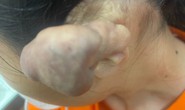 Khối u khủng của cô gái và cảnh báo việc xỏ khuyên khắp cơ thể
