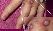 Sau châu Âu, tới lượt Mỹ dính bệnh đậu mùa khỉ hiếm gặp